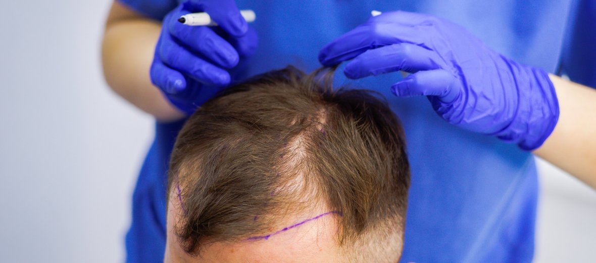 Сколько стоит пересадка волос на голове у мужчин в ростове thumbnail